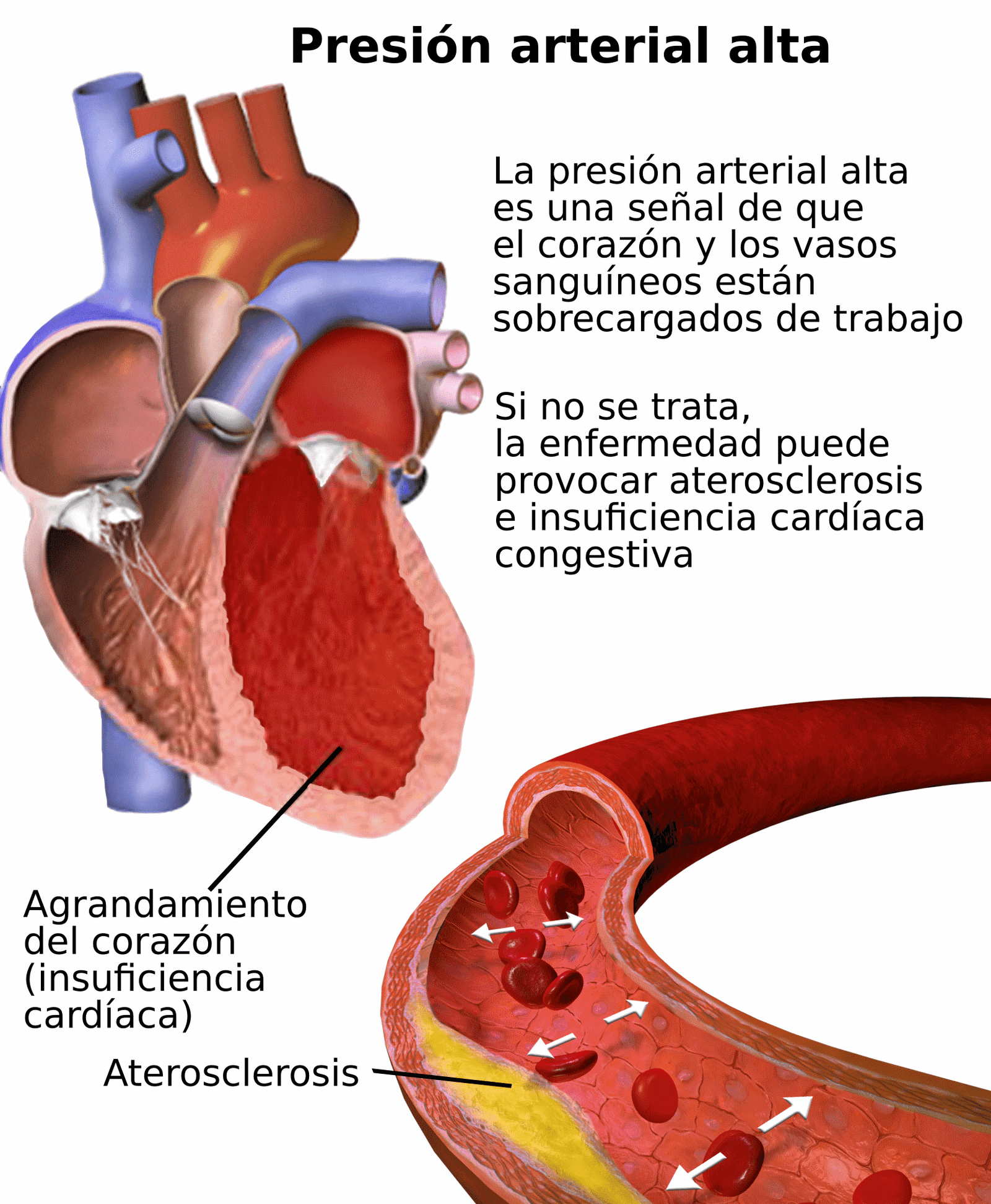 Hipertensión arterial y la Diabetes