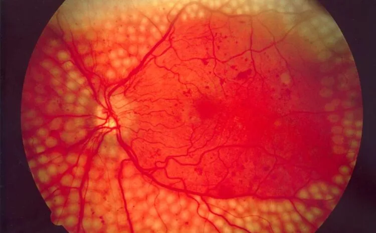 Retinopatía Diabética